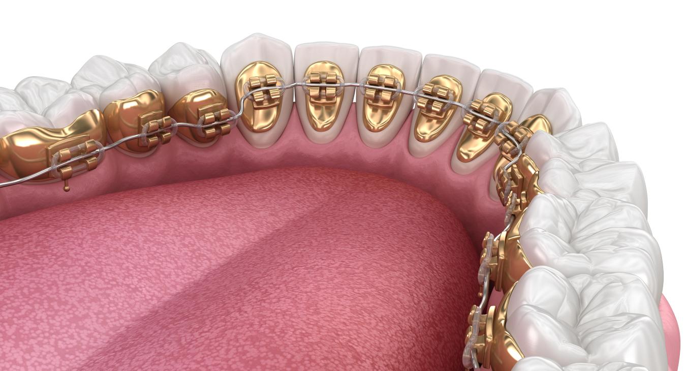 L'orthodontie linguale 