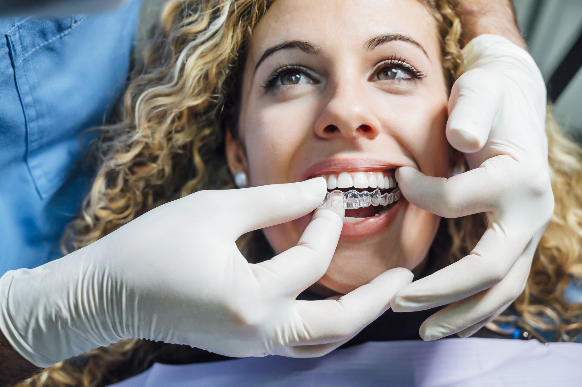 Les gouttières transparentes Invisalign : la solution orthodontique invisible pour un sourire parfait