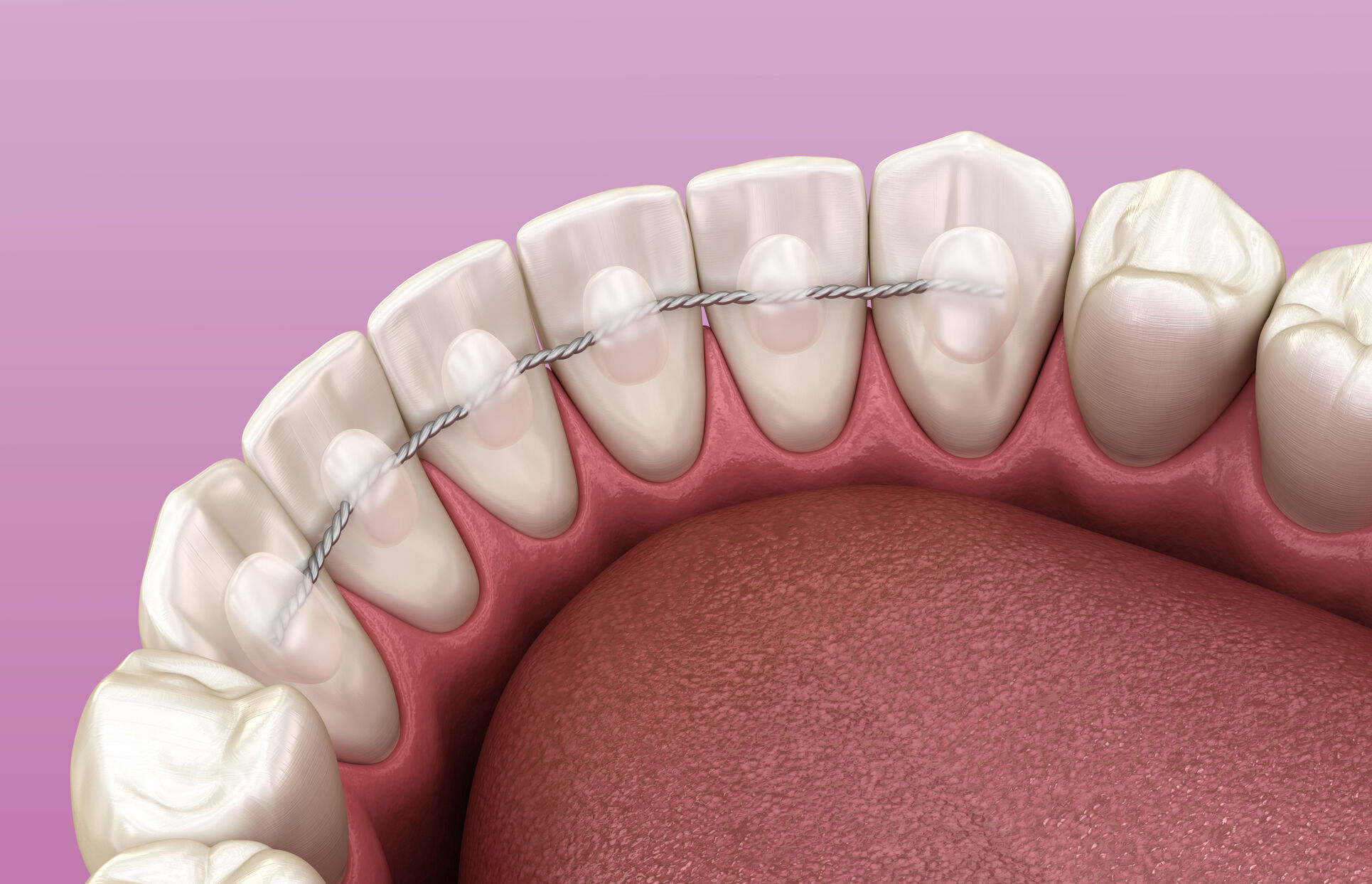 La contention en Orthodontie