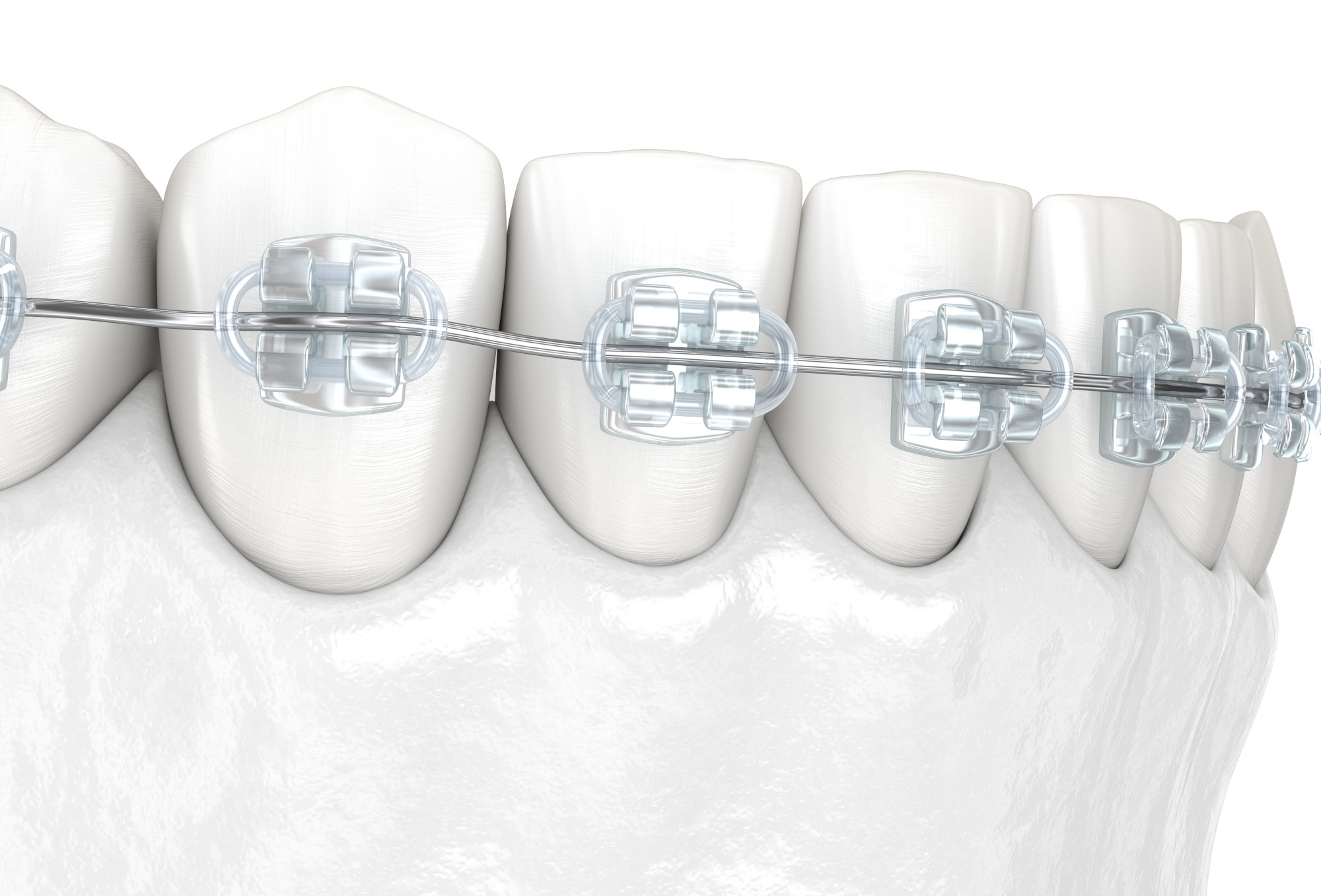 Orthodontie avec bagues ou brackets