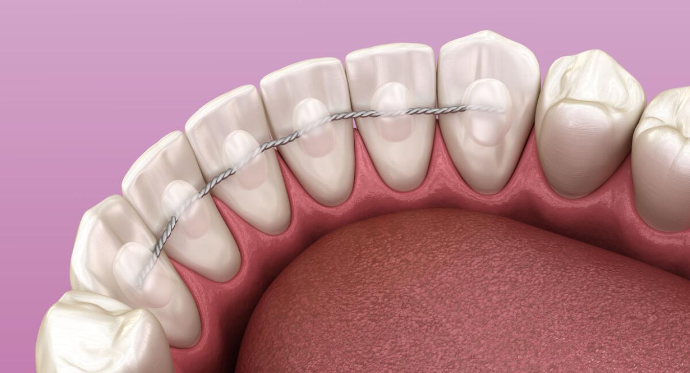 Contention en Orthodontie